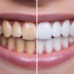 A Detailed Before and After Comparison of Teeth Whitening Results for Achieving a Brighter and Healthier Smile