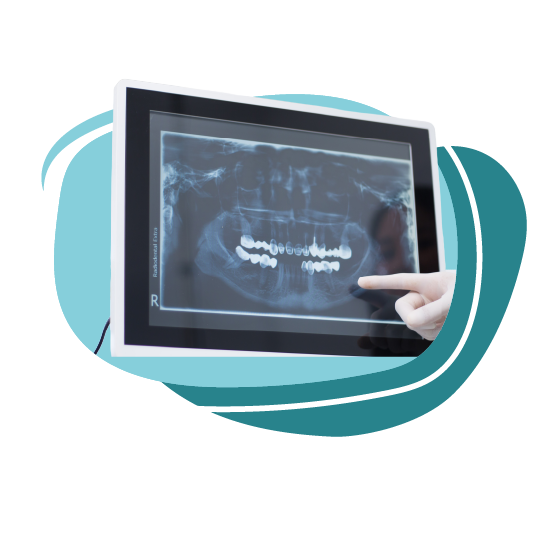 دراسة الحالة ( كشف أخصائي تقويم الأسنان + خطة علاجية + أشعة بانوراما + أشعة سيفالومترك + طبعات الماسح الضوئي iTero )