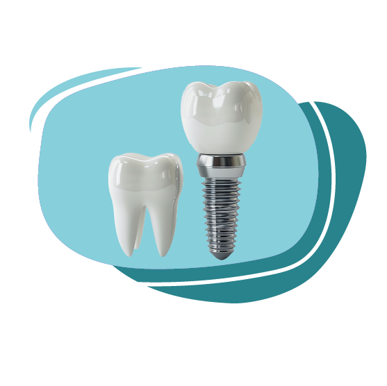 زراعة سن + تركيبة + أشعة 3D ثلاثية الأبعاد + كشف استشاري  الزراعة